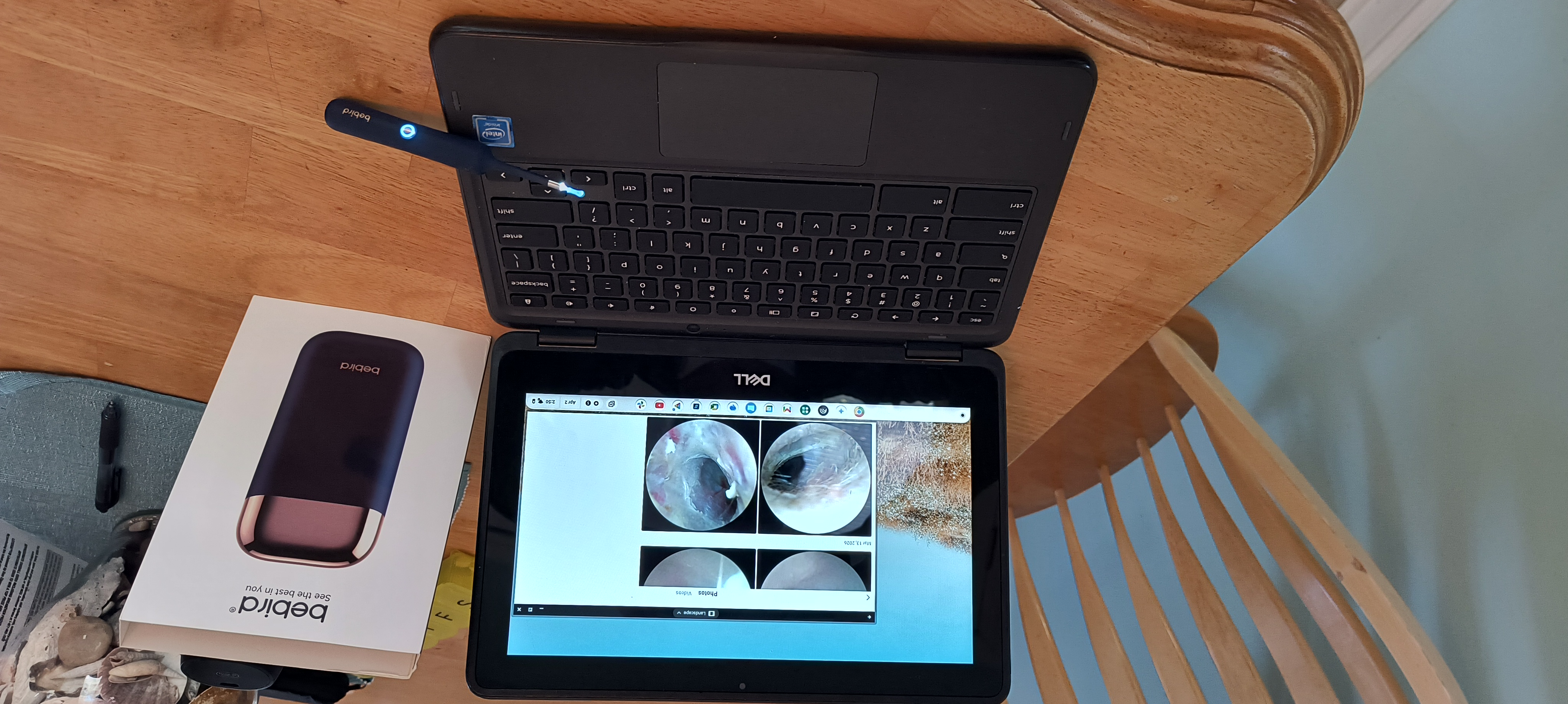 Could Earwax Be a Cause for My Hearing Loss?